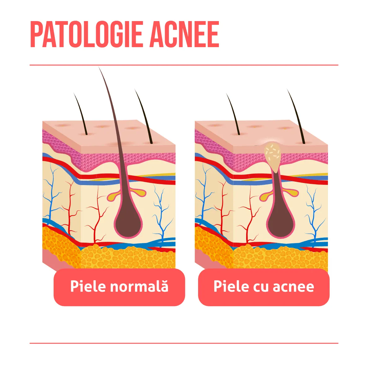Patologie acnee