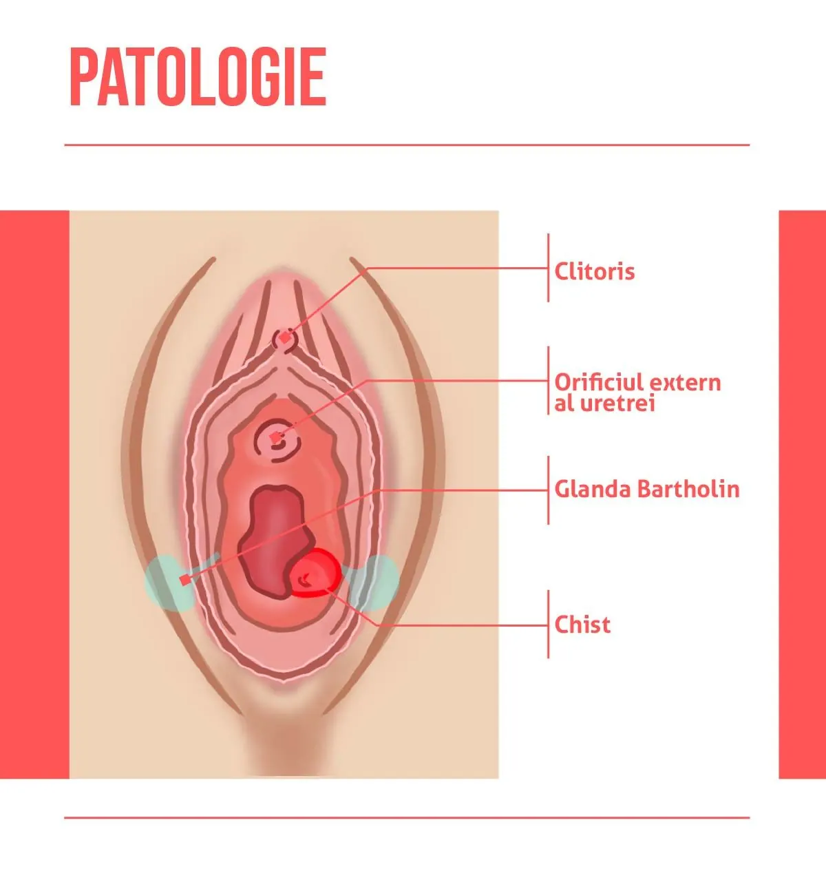 Patologia chistului Bartholin