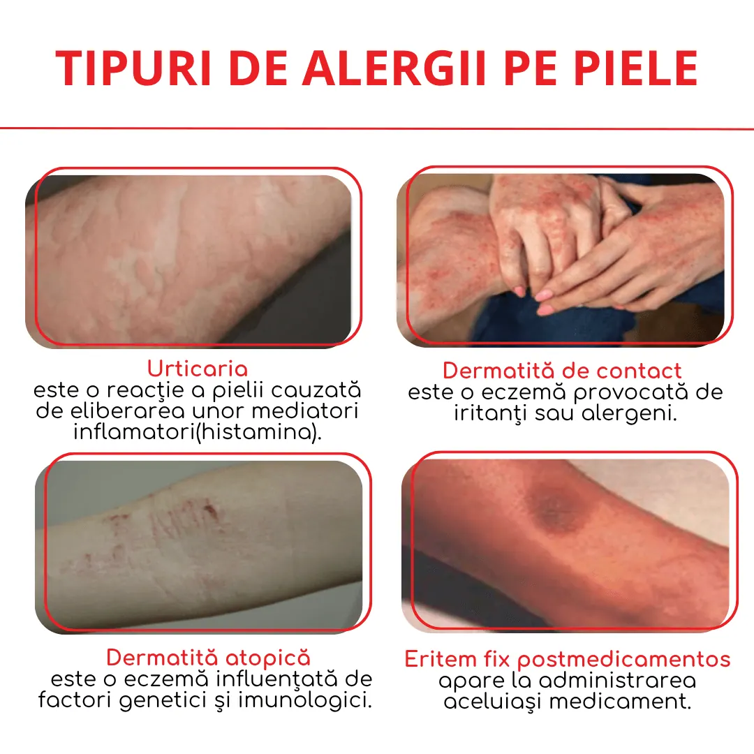 tipuri de alergii pe piele