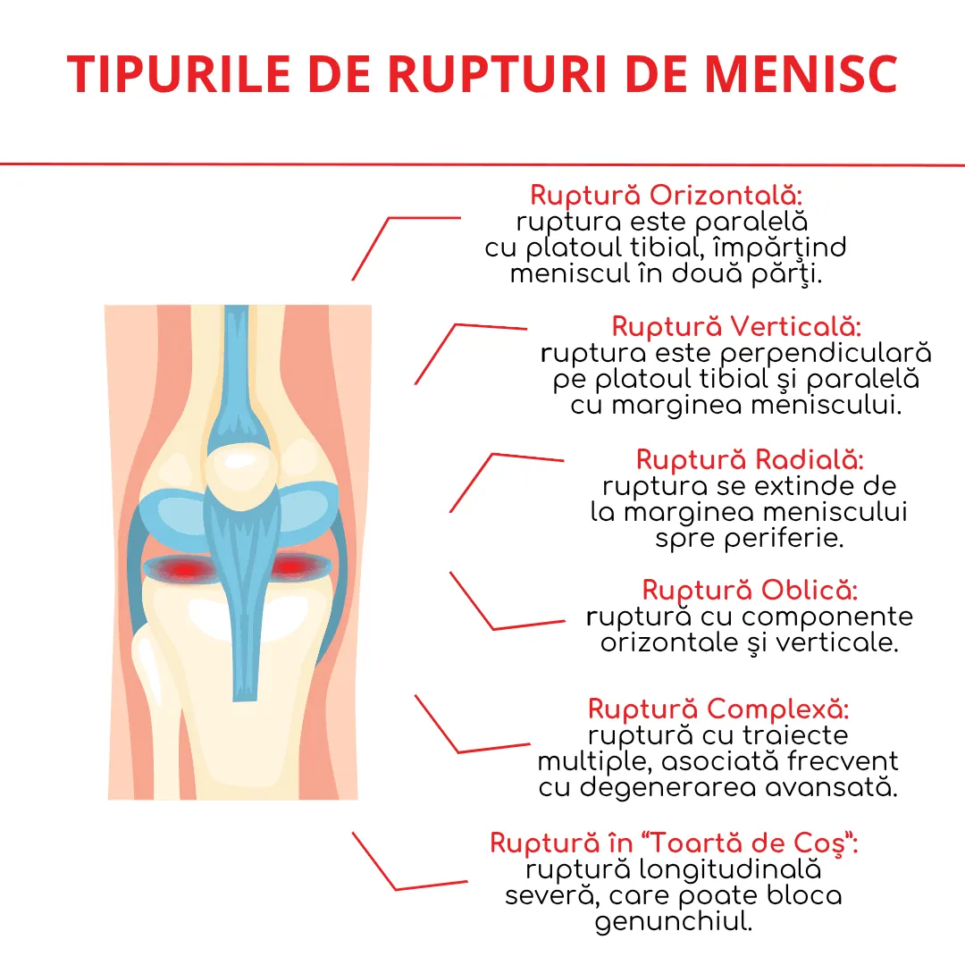 tipurile de rupturi de menisc