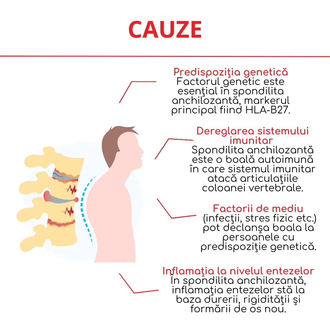cauze spondilita anchilozanta