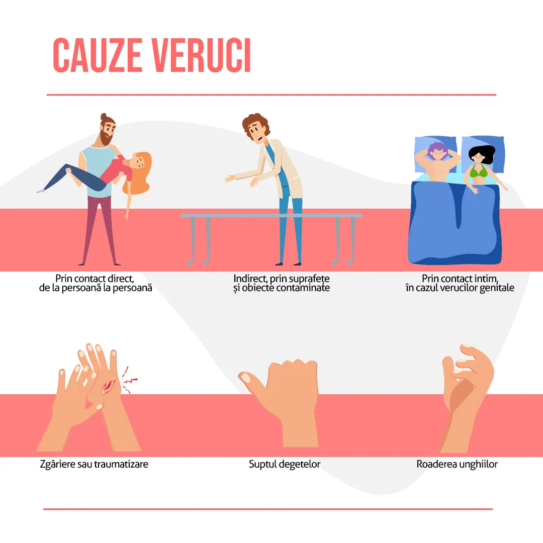Cauze veruci