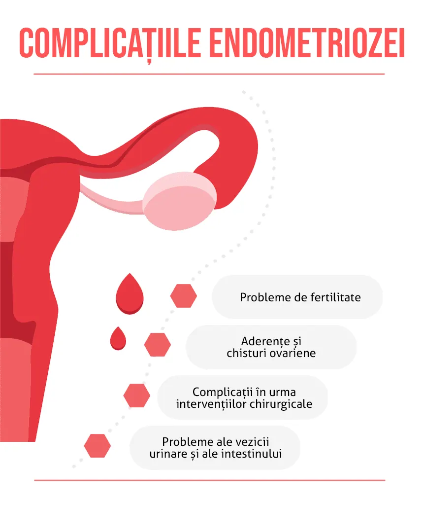 Complicatiile endometriozei