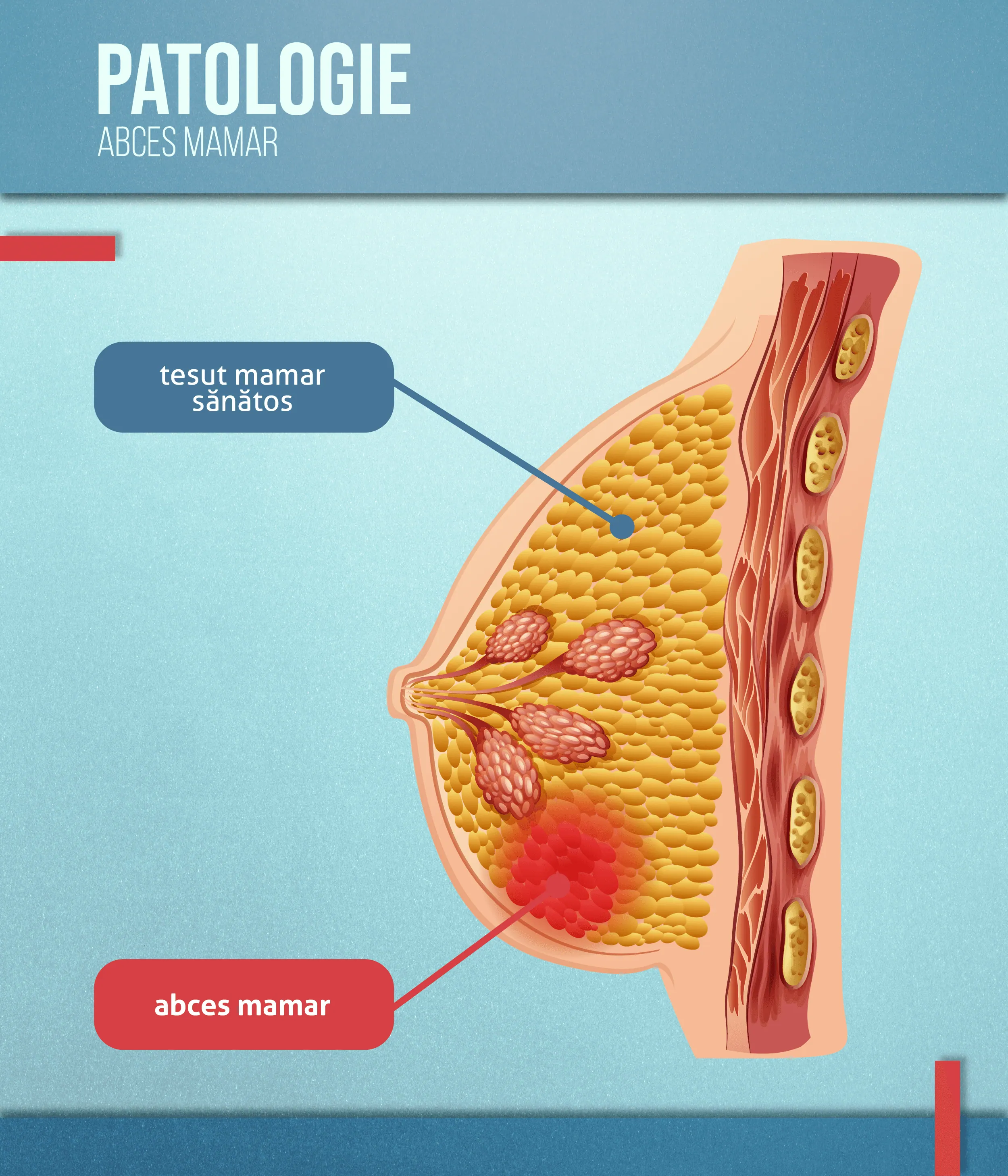 Patologie abces mamar