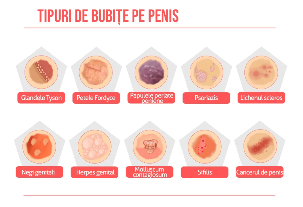 Tipuri de bubite pe penis