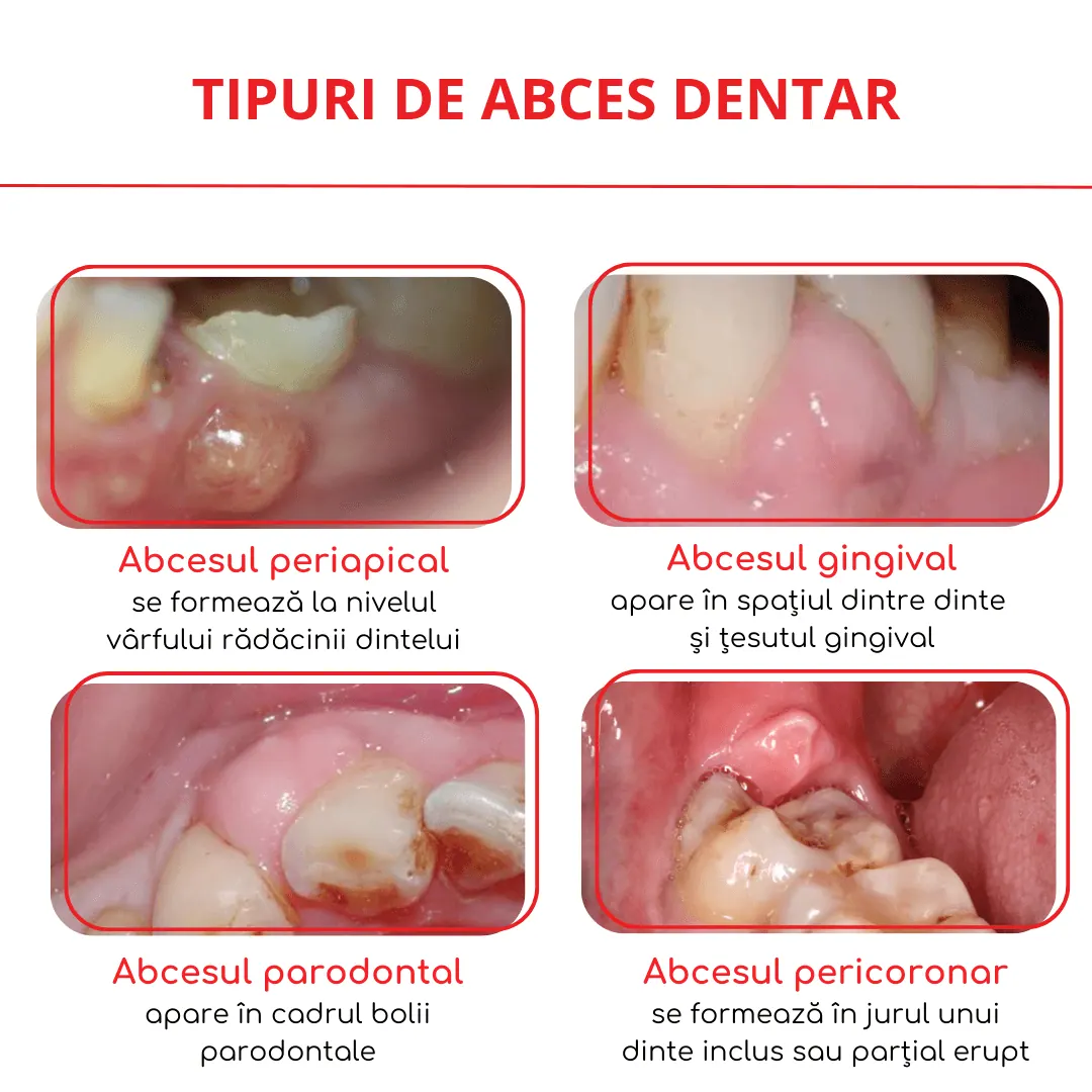 tipuri de abces dentar
