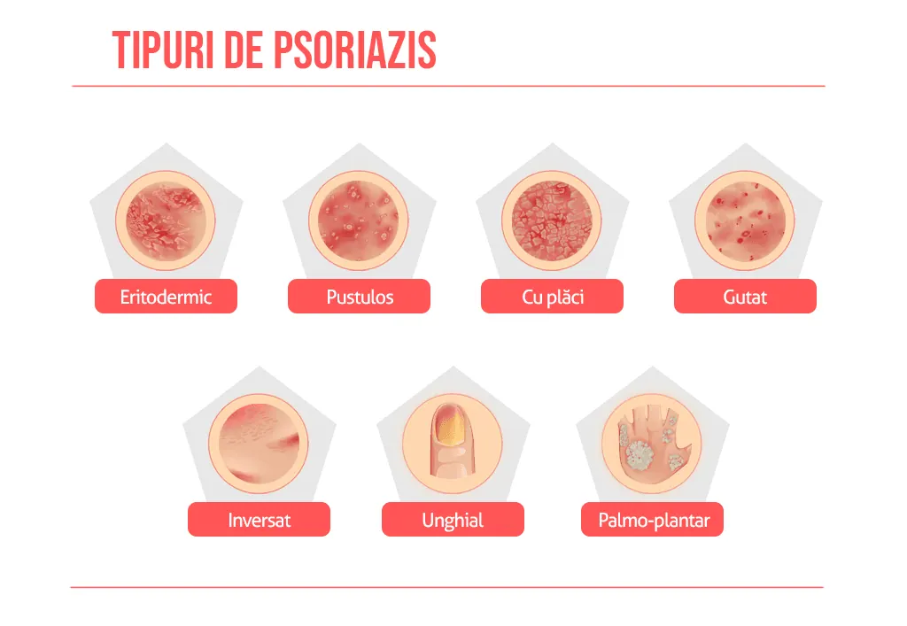 Psoriazis